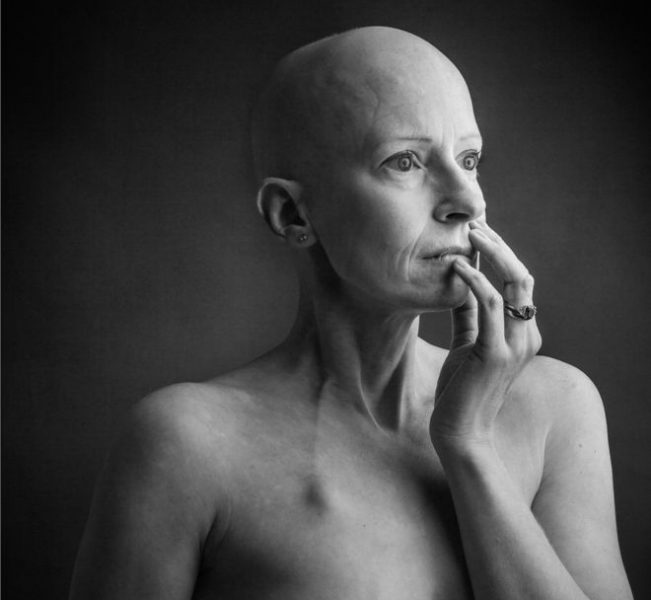 «Como muchas mujeres, no me revisé los senos»: la cirujana que operaba cáncer de mama y lo tuvo