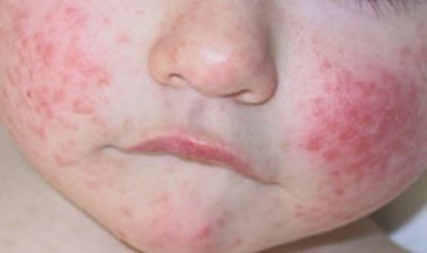 Dermatitis atópica, la enfermedad cutánea más frecuente en la niñez