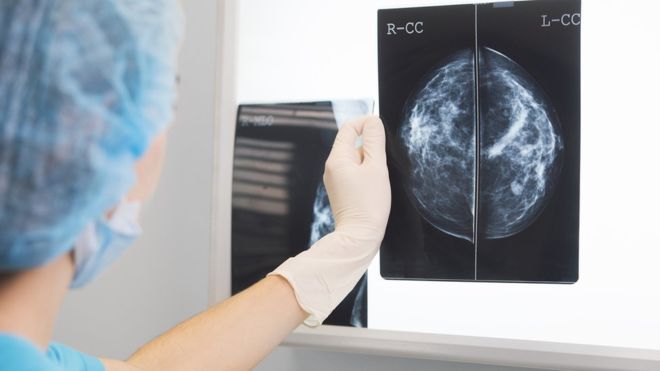 Cómo la inteligencia artificial «supera a médicos» en el diagnóstico de cáncer de mama