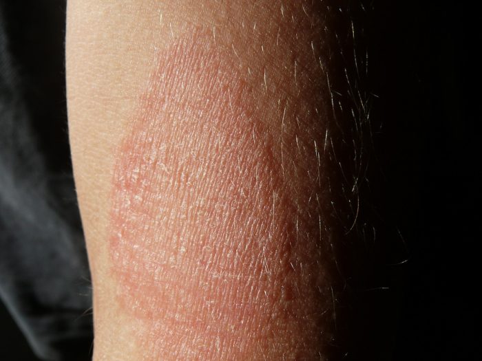 ¿Cómo es vivir con dermatitis atópica en Chile?