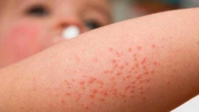 Día Internacional de la Dermatitis Atópica: una enfermedad poco conocida que afecta a miles de personas en Chile 