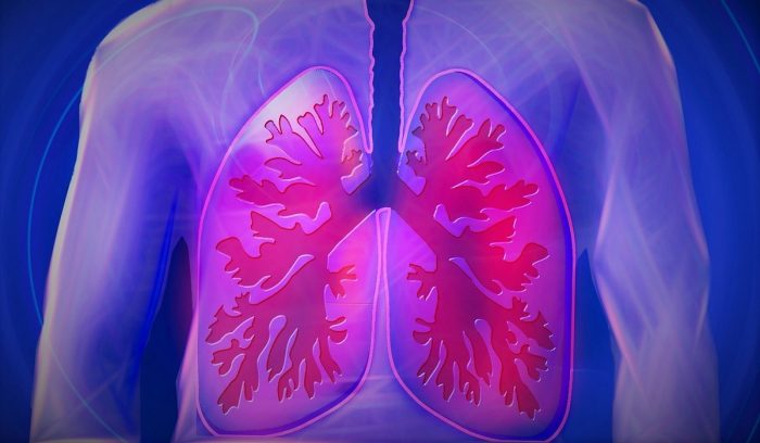¿Cuáles son los síntomas para reconocer la Fibrosis Pulmonar Idiopática?