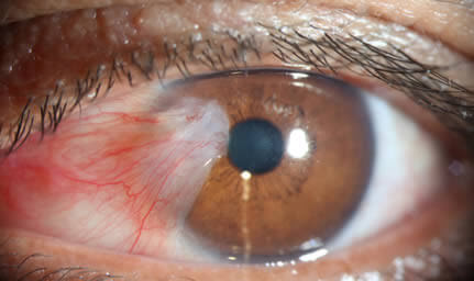 Encuentran anomalías oculares en algunos casos graves de covid-19