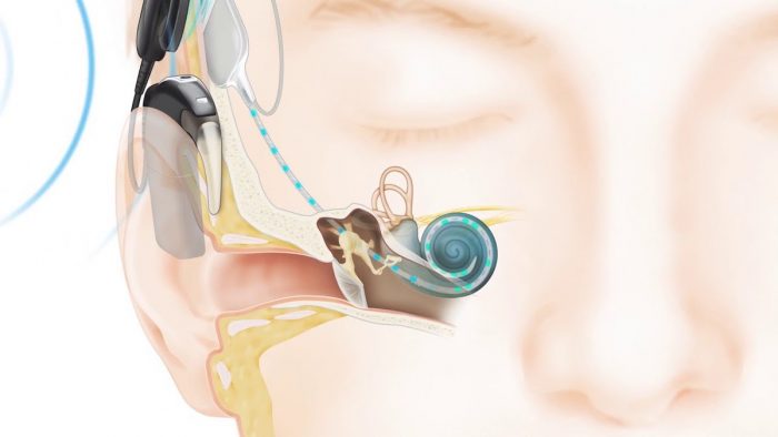 Día del implante coclear: un oído biónico para chilenos con pérdida auditiva