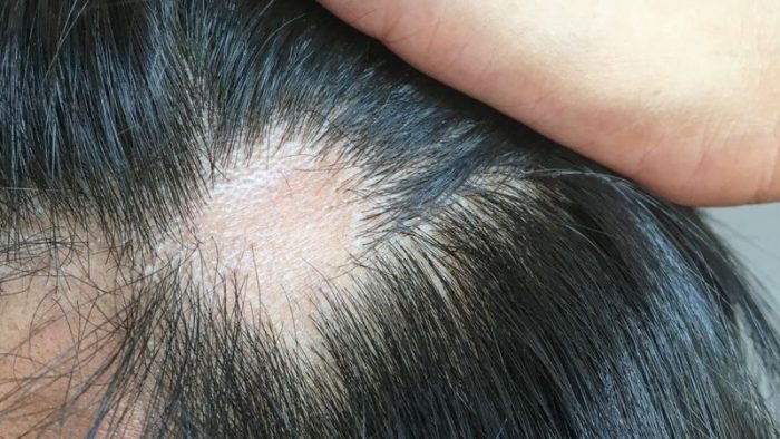 Coronavirus: qué causa y cómo tratar la caída del cabello que afecta a uno de cada cuatro infectados