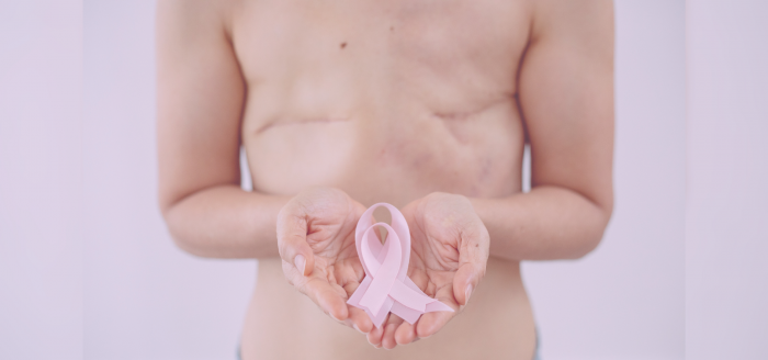 Un nuevo fármaco podría elevar la supervivencia del cáncer de mama HER2 positivo al 95 %