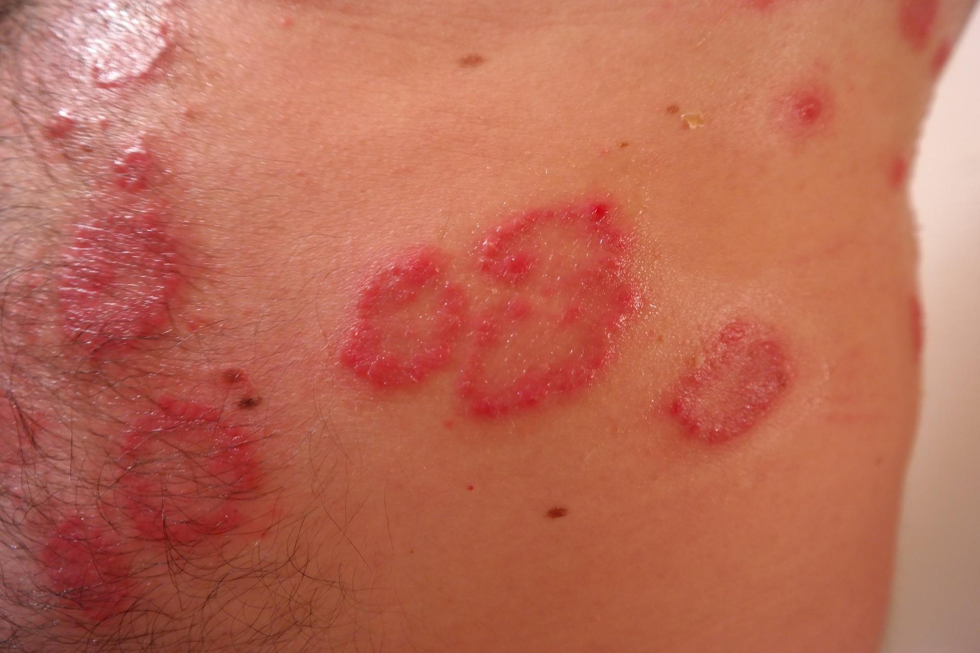 Mitos y realidades en torno a la psoriasis