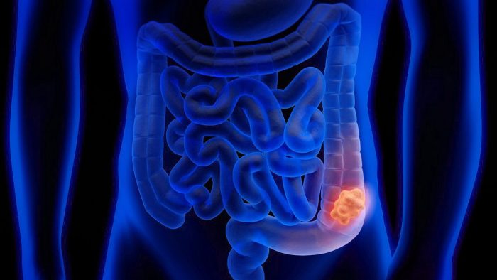 Cáncer de colon: más de 500 personas son diagnosticas cada mes y es el segundo más frecuente en Chile