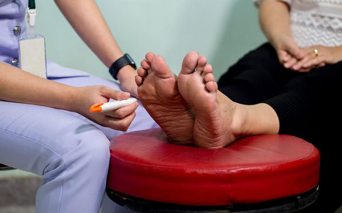 El pie diabético es la principal causa de amputación en el país