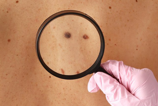El sencillo autoexamen que puede ayudarte a prevenir el cáncer de piel