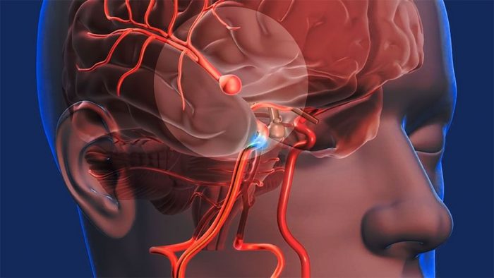 Ataque Cerebro Vascular: la rapidez en la atención es clave para una recuperación exitosa o  disminuir secuelas