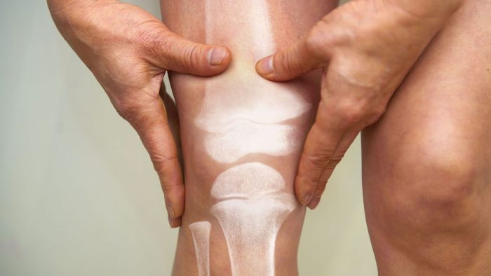 Osteoporosis: otro de los efectos negativos que está dejando la pandemia