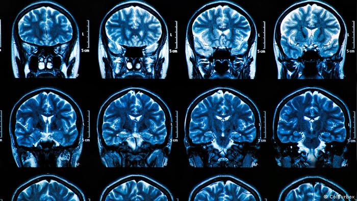 Un fármaco experimental contra el alzheimer logra frenar el deterioro cognitivo