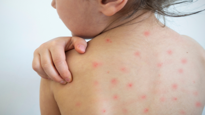 Especialistas llaman a ponerse al dia con segunda dosis de vacuna contra la varicela 