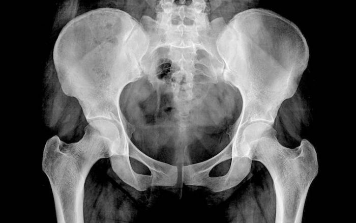 Osteoporosis: qué debemos comer para prevenirla