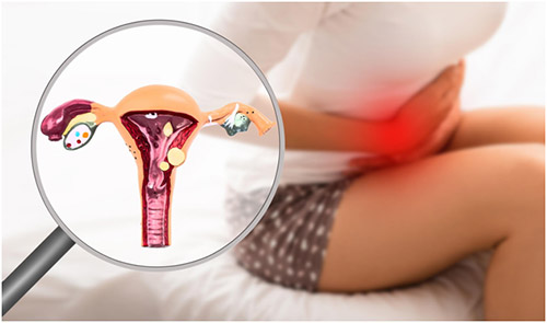 Endometriosis: su posible relación con el sistema inmunológico