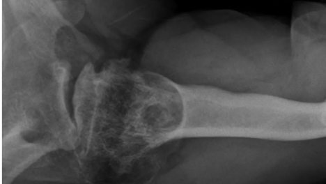 Osteonecrosis disbárica: la silenciosa enfermedad que corroe a los buzos salmoneros al sur de Chile