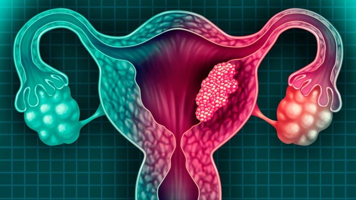 Test de VPH: el examen que previene el cáncer cervicouterino en cientos de mujeres