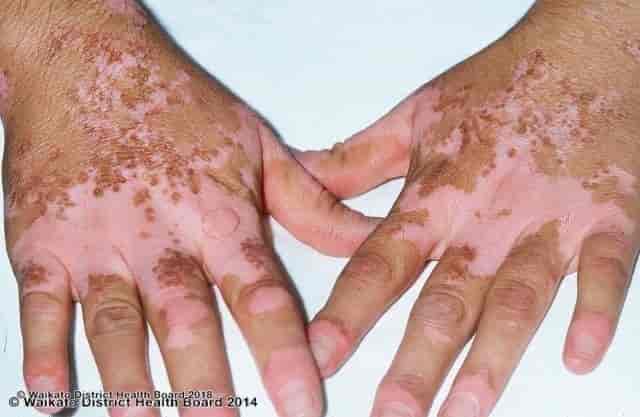 Vitiligo: lo que debes saber sobre esta enfermedad autoinmune