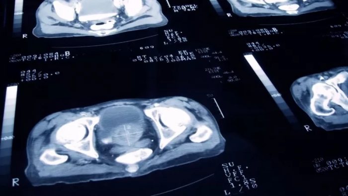 El estudio que revela que el cáncer de próstata se puede curar con menos sesiones de radioterapia