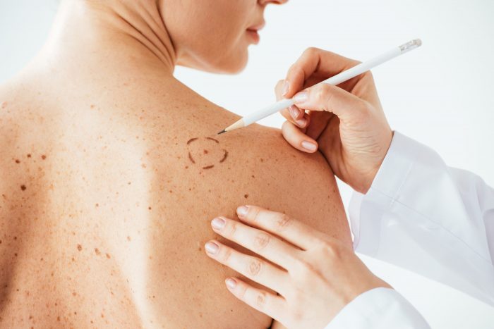 Aumento de cáncer de piel en Chile: cinco señales que no debes ignorar