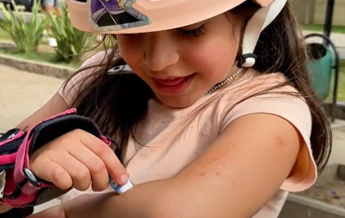 Cicatrices en niños y niñas: ¿Cómo tratarlas?