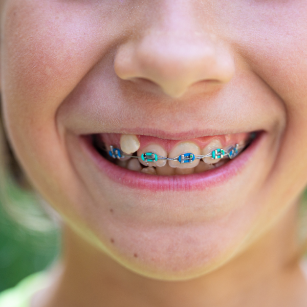 Ortodoncia preventiva: La importancia de detectar problemas dentales en la niñez