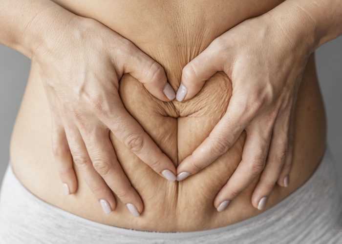 Diástasis abdominal: conoce cómo tratar esta condición desconocida que afecta tu salud y autoestima