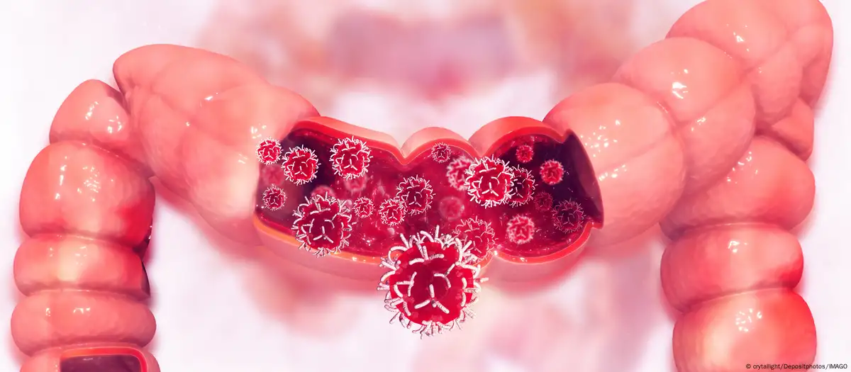 Cáncer intestinal aumenta entre jóvenes de todo el mundo