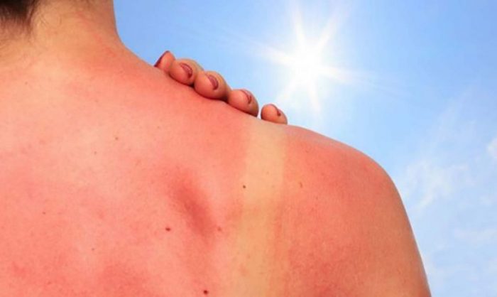 Linfogammagrafía y PET-CT: procedimientos que ayudan a la detección y tratamiento del cáncer de piel