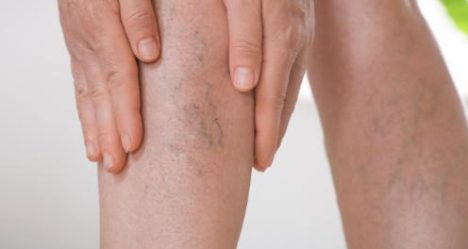 Lipedema: las 7 enfermedades con las que se confunde y cómo detectarlo a tiempo en Chile