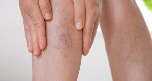 Lipedema: las 7 enfermedades con las que se confunde y cómo detectarlo a tiempo en Chile