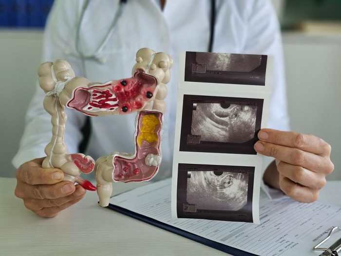 Cáncer de apéndice: el raro tumor gastrointestinal que preocupa a jóvenes y especialistas