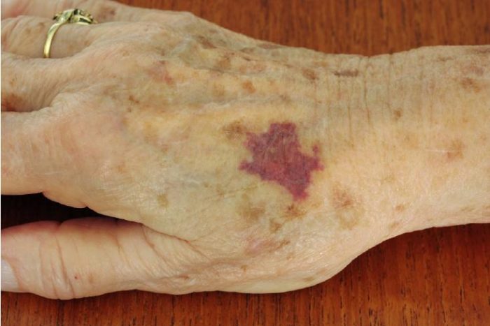 Moretones sin golpes en adultos mayores: causas, cuándo preocuparse y cómo prevenirlos