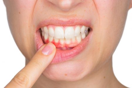 Periodontitis: el sangrado de encías podría ser el inicio de una enfermedad grave y silenciosa