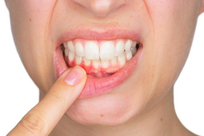 Periodontitis: el sangrado de encías podría ser el inicio de una enfermedad grave y silenciosa