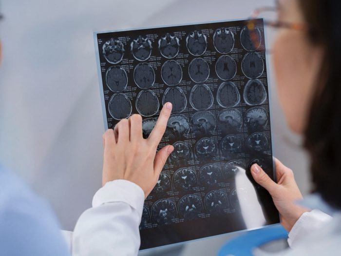 Enfermedades cerebrales más comunes en Chile: ACV, demencia y Parkinson lideran la lista