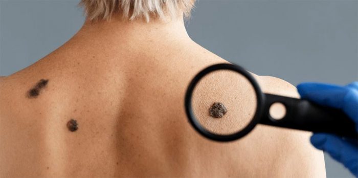 Verrugas en la piel: cómo identificarlas, prevenir el contagio y tratarlas de forma segura