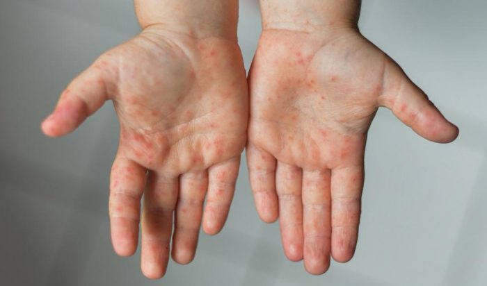 Aumentan casos de enfermedad Boca, Mano y Pie en Atacama: medidas de prevención en jardines infantil