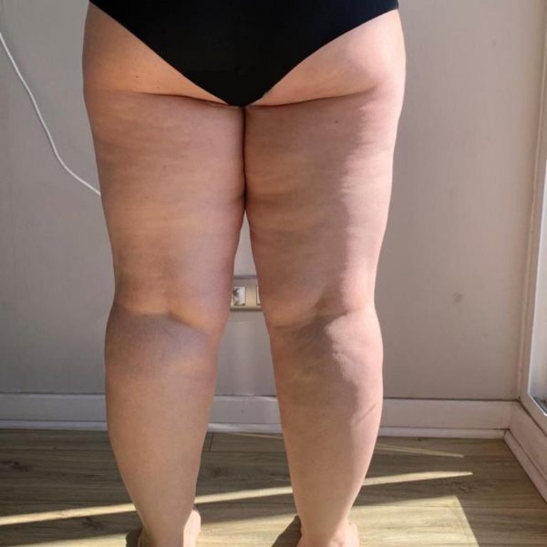 Chile lanza primera encuesta nacional de lipedema, enfermedad crónica que afecta a mujeres