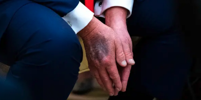 El llamativo moretón en la mano de Trump y los rumores sobre su salud