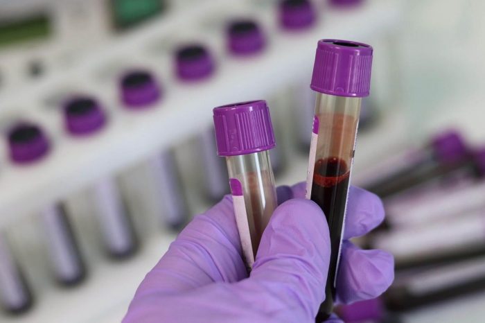 Mieloma múltiple: el cáncer de sangre que podría superar los 300 mil casos en 2045