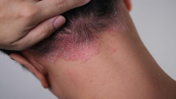 Psoriasis y sus mitos: una enfermedad crónica no contagiosa con factores genéticos y emocionales
