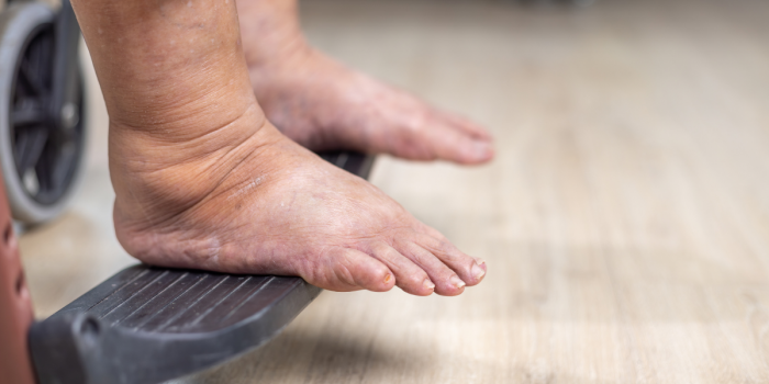 Cáncer de mama y linfedema: la enfermedad silenciosa que puede aparecer tras el tratamiento