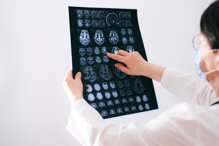 Epilepsia: tratamientos para restablecer y reparar el cerebro