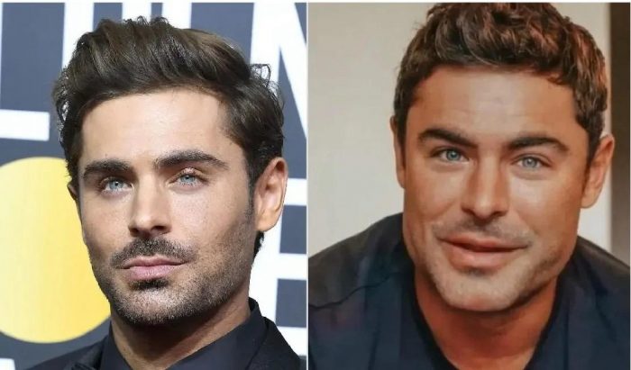 Pillow face o cara de almohada: cómo prevenir este efecto al usar rellenos faciales en el rostro