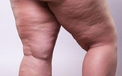 Lipedema: expertas chilenas destacan en congreso mundial en Roma y refuerzan liderazgo regional