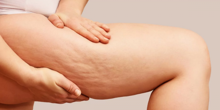 Lipedema: la enfermedad invisibilizada que irrumpe entre las búsquedas más populares de Google 2025