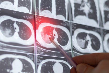 Cáncer de pulmón: por qué el “screening” es clave para detectar la enfermedad a tiempo