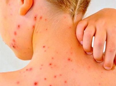 Alerta por sarampión en Chile: Minsal refuerza vigilancia y expertos urgen a aumentar vacunación